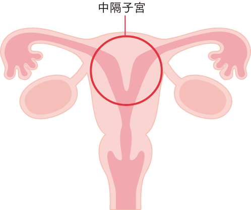 子宮の形成異常