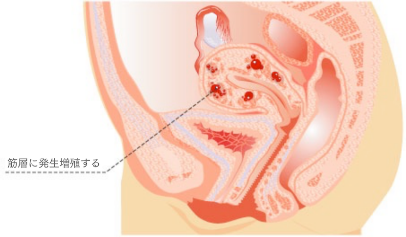 子宮腺筋症